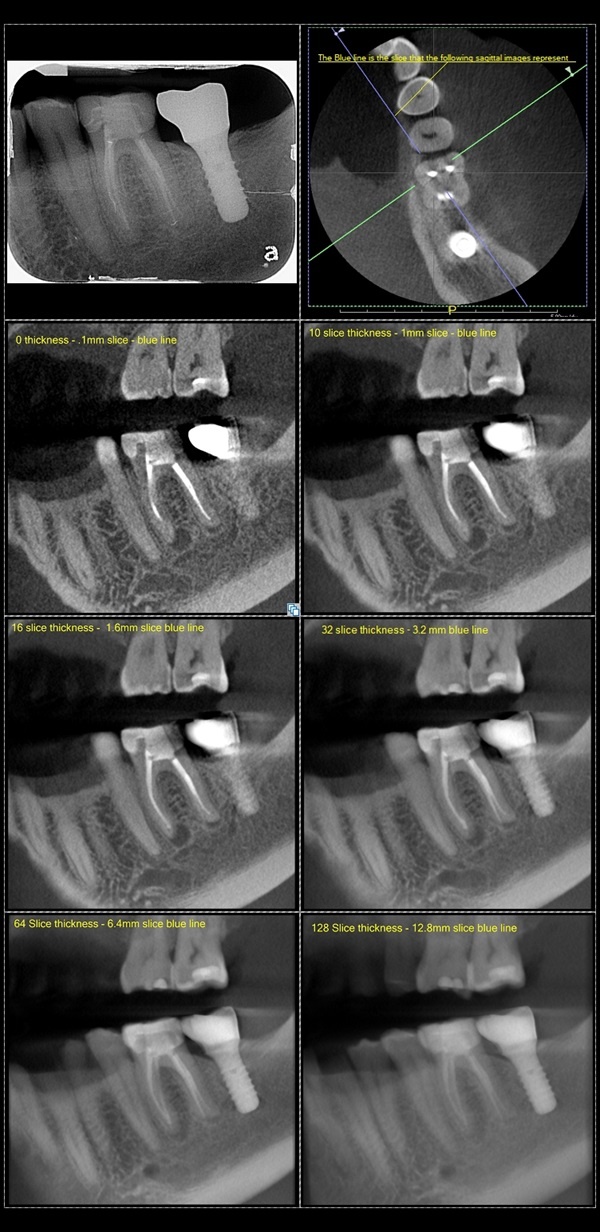 Varying Slice Thickness A Practical Example of CBCT for Endo